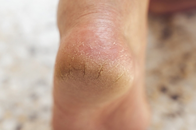 Link Between Cracked Heels and Thyroid Health