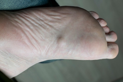 Plantar Fibromatosis